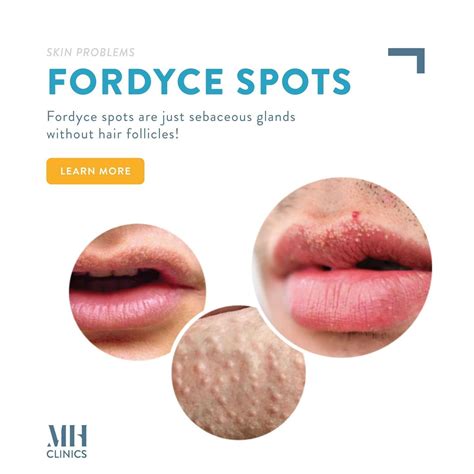 grain de fordyxe|Fordyce spots